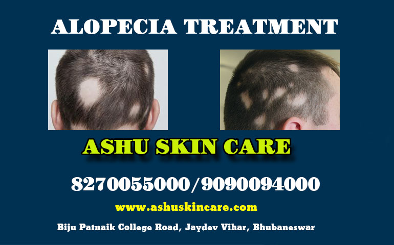best alopecia treatment clinic  in bhubaneswar near aditya care hospital